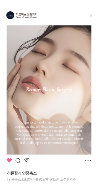 리트머스성형외과 안면윤곽 전후사진 이미지