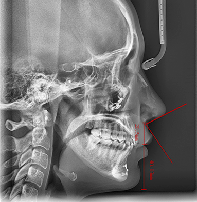 리트머스성형외과 인중축소술 point 02 이미지