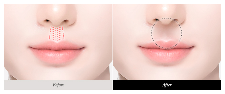 리트머스성형외과 인중기둥성형술 이미지