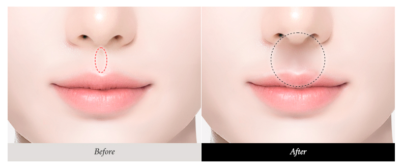 리트머스성형외과 인중골재생술 이미지