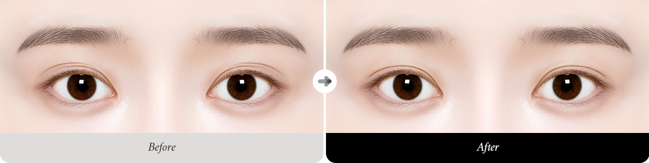 리트머스성형외과 눈재수술 추천대상 이미지