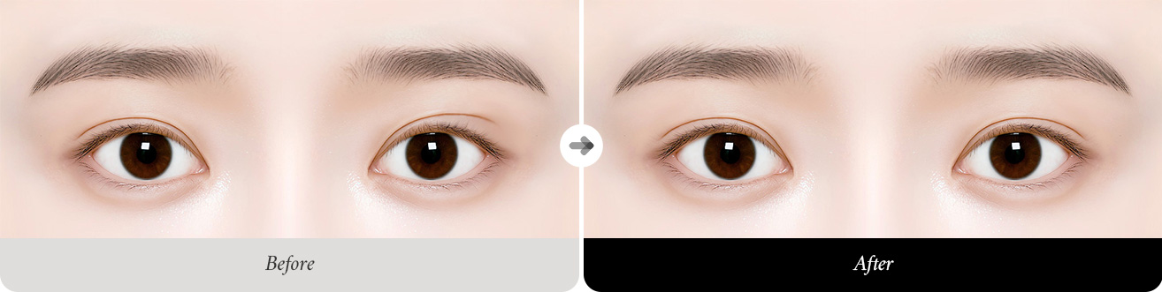 리트머스성형외과 눈재수술 추천대상 이미지