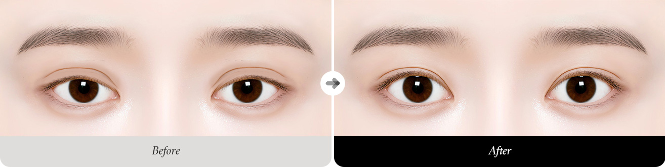 리트머스성형외과 눈재수술 추천대상 이미지