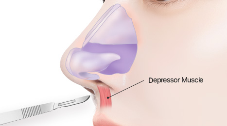 리트머스 화살코 수술방법 이미지