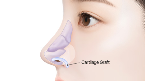 리트머스 용코/찝힌코 수술방법 이미지