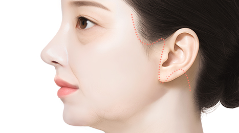 리트머스성형외과 수술방법 이미지