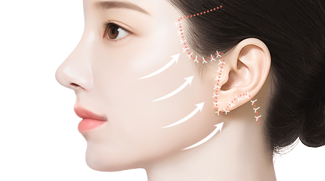 리트머스성형외과 수술방법 이미지