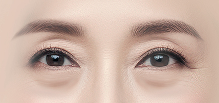 Lower Blepharoplasty