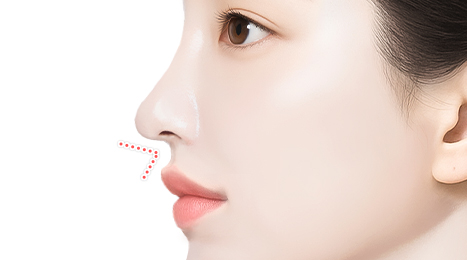 리트머스 인중코,인중코끝 수술방법 이미지