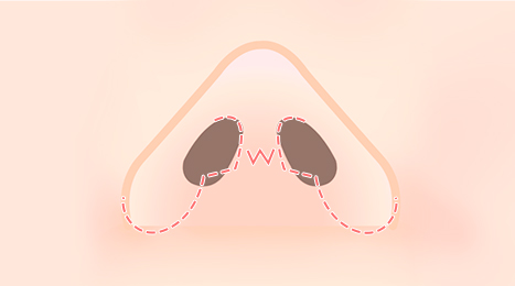 리트머스 인중축소재수술 수술방법 이미지