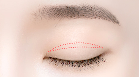 리트머스성형외과 수술방법 이미지