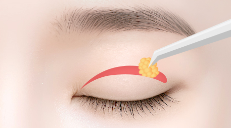 리트머스성형외과 수술방법 이미지