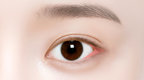 리트머스성형외과 수술방법 이미지