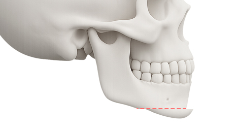리트머스성형외과 수술방법 이미지