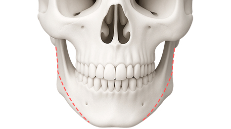 리트머스성형외과 수술방법 이미지