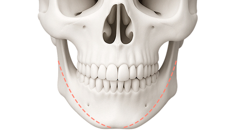 리트머스성형외과 수술방법 이미지