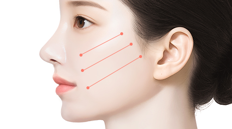 리트머스성형외과 수술방법 이미지