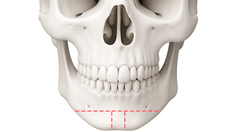 리트머스성형외과 수술방법 이미지