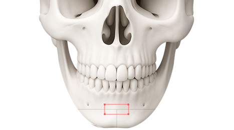 리트머스성형외과 수술방법 이미지