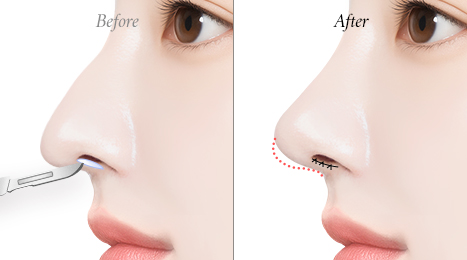 리트머스 화살코 수술방법 이미지