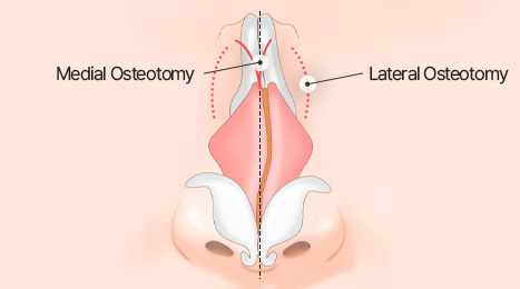 리트머스 휜코 수술 방법 이미지