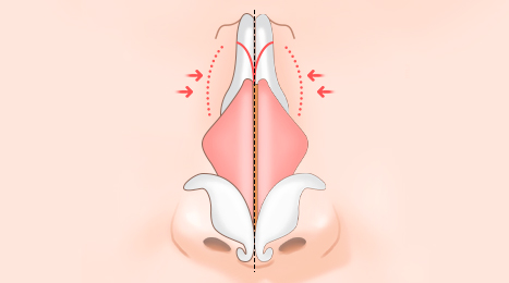 리트머스 휜코 수술 방법 이미지