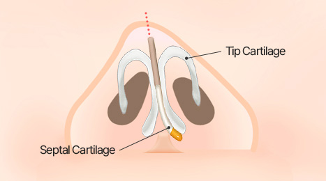 리트머스 비중격연골 휜코 수술 방법 이미지