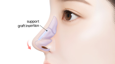 리트머스 들창코 수술방법 이미지
