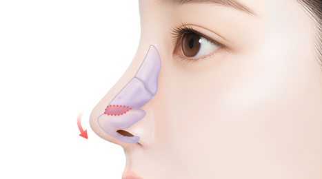 리트머스 구축코 수술방법 이미지