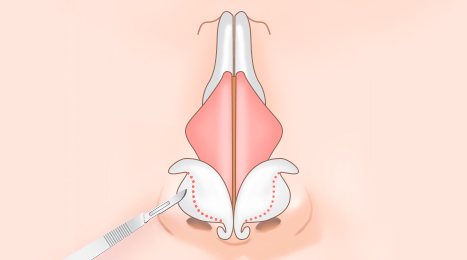리트머스성형외과 복코 수술 이미지