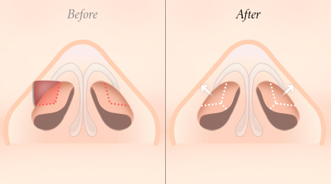 리트머스 용코/찝힌코 수술방법 이미지