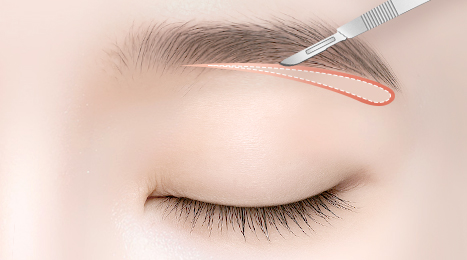 리트머스성형외과 눈썹거상 수술방법 이미지