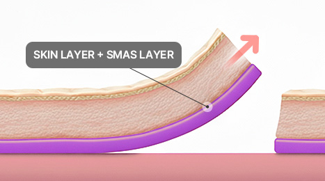 리트머스성형외과 수술방법 이미지