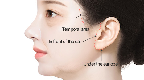 리트머스성형외과 미니거상 수술방법 이미지