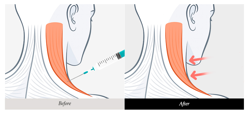 리트머스성형외과 넥슬림주사, 승모근 보톡스 이미지