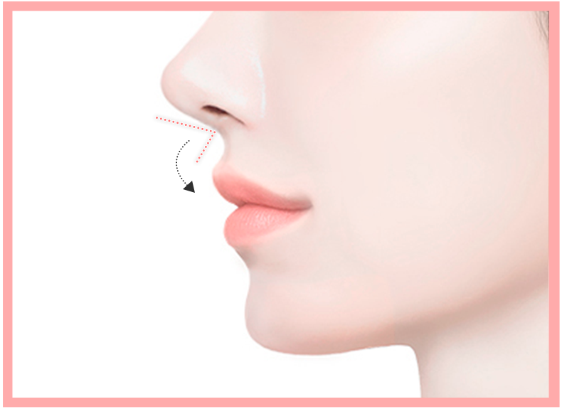 리트머스성형외과 인중축소 c컬 후 일러스트 이미지