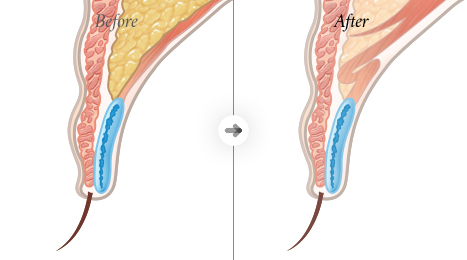 리트머스성형외과 수술방법 이미지