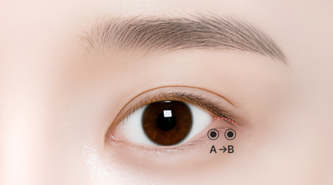 리트머스성형외과 수술방법 이미지