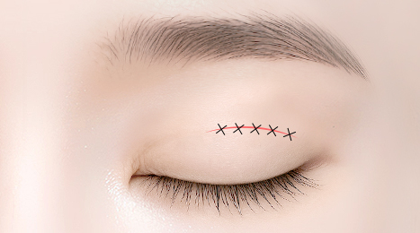 리트머스성형외과 상안검 수술방법 이미지