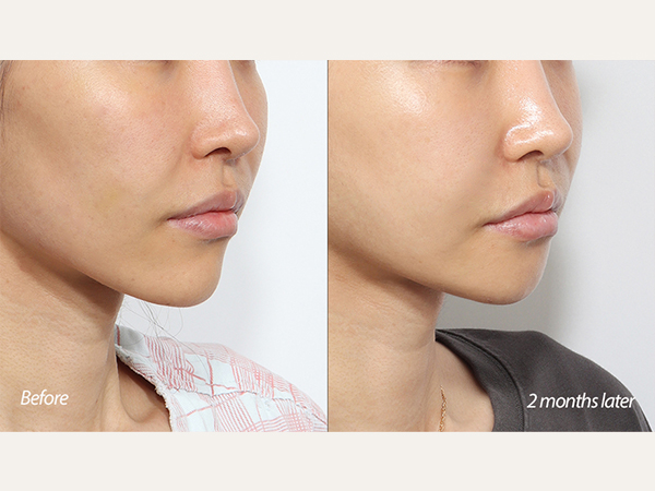 facial contouring - cheekbone and chin reduction