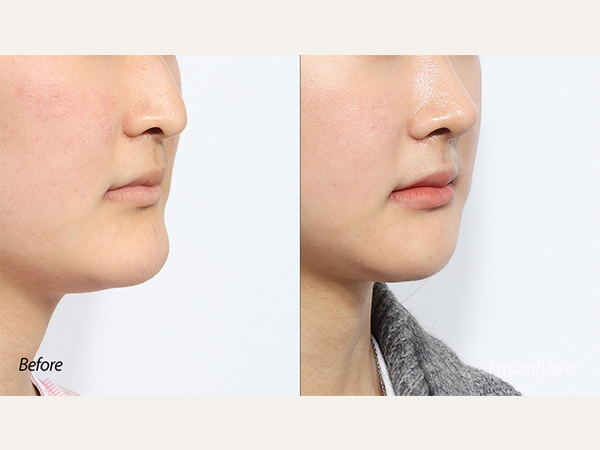 facial contouring - mini V-line surgery (jaws, and chin reduction)