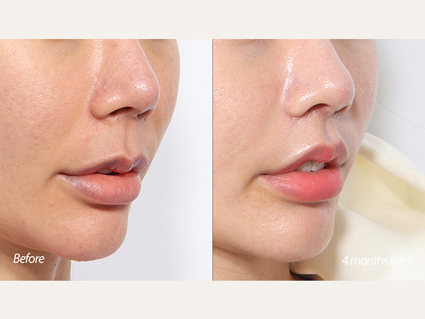 lip lift and revision tip plasty