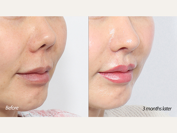lip lift and revision rhinoplasty