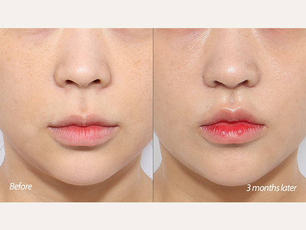 lip lift and tip plasty