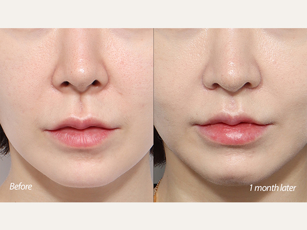 lip lift and revision tip plasty