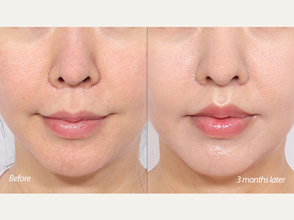 lip lift and revision rhinoplasty
