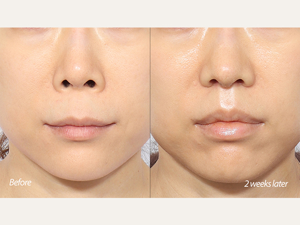 lip lift and revision tip plasty