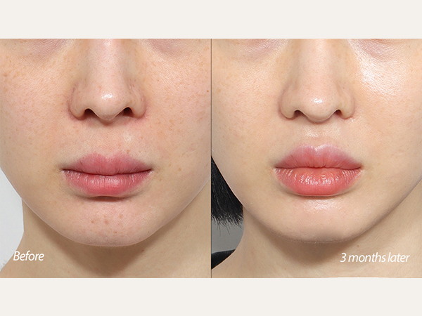 lip lift and revision tip plasty
