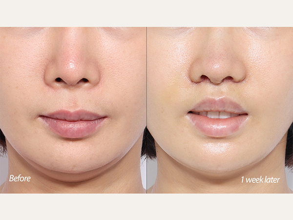 lip lift and revision tip plasty