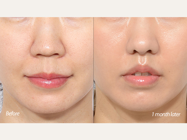 lip lift and revision rhinoplasty